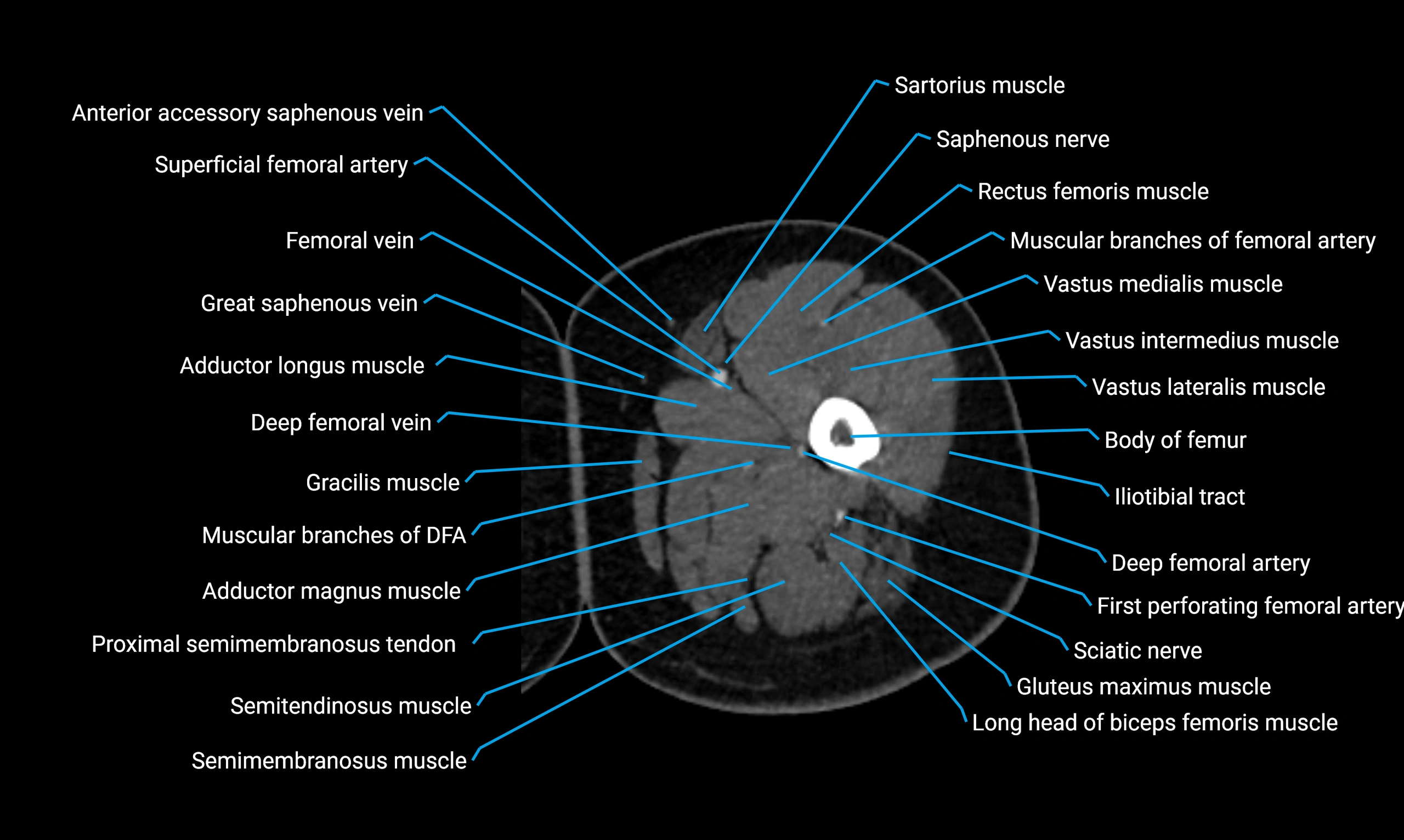 CT lower limb axial cross sectional anatomy labelled image 35 (2).webp